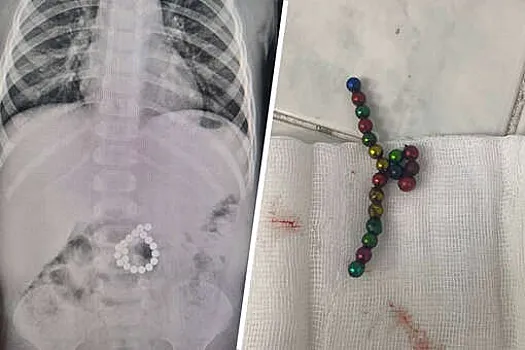 В ХМАО ребенок проглотил 19 магнитов и попал в реанимацию